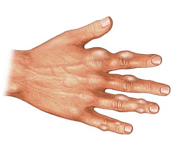 Deposizione di cristalli di acido urico nei tessuti molli delle dita nell'artrite gottosa