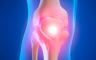 Cause dell'osteoartrosi dell'articolazione del ginocchio
