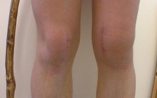 Stadi di sviluppo dell'osteoartrosi del ginocchio