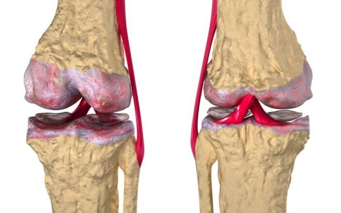Artrosi dell'articolazione del ginocchio