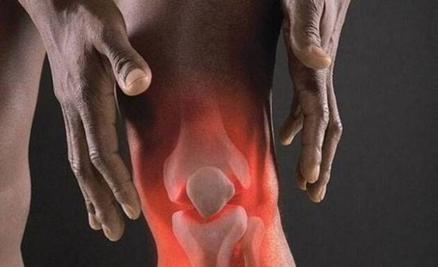 L'artrosi è accompagnata da un processo infiammatorio nell'articolazione del ginocchio